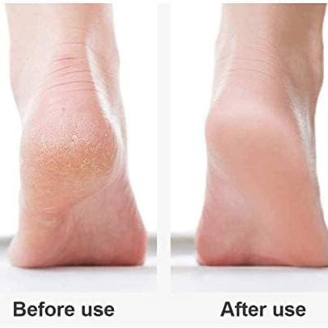 Foot Grinder Electric Callus Remover