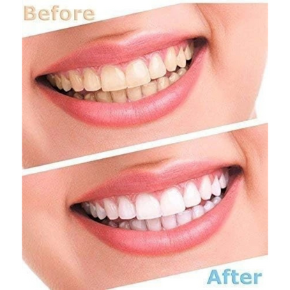 Electric Tooth Polisher Whitener & Stain Remover with LED Light Technology.